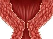 Inositol Dieta Ovarios Poliquísticos