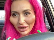 #Belleza #Salud #Vanidad: desfiguró rostro aplicarse colágeno pómulo #Botox