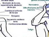 Hypothyroidism