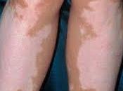 Vitiligo causas consecuencias enfermedad