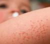 frío llegan afecciones piel como dermatitis