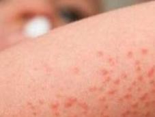 frío llegan afecciones piel como dermatitis