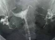 Histerosalpingografia