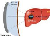 seguro ultrasonido para destruir células cancerosas