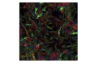 Nueva estrategia para tratar accidente cerebrovascular