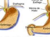 Hernia hiato