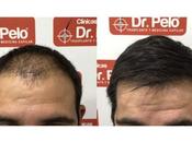 Señales alopecia Clínicas Pelo