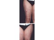 Dermatitis autoinmune progesterona