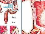 Significado clinicopatológico carcinoma sincrónico cáncer colorrectal