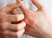 baricitinib eficaz pacientes dermatitis atópica