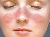 Lupus