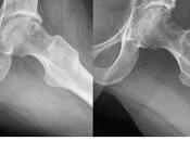 Choque femoro acetabular