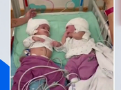 Israel: Siamesas unidas cabeza pudieron verse frente primera tras exitosa cirugía