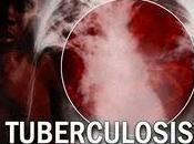 Infecciones conseguimos erradicar: tuberculosis