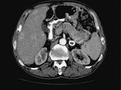 Trasplante hígado para tratamiento metástasis hepáticas tumores neuroendócrinos