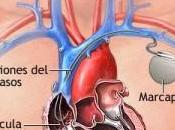 Días Marcapasos Podrían Estar Contados