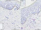 Cómo desarrolla Dermatitis Atópica