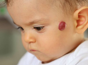Manchas rojas desde nacimiento: hemangiomas infantiles