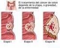 trabajadores tiene "riesgo incrementado" padecer cáncer colorrectal