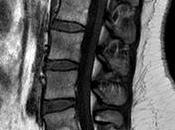 resonancia magnética lumbar sólo debe realizarse casos excepcionales según estudio Fundación Kovacs