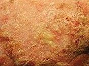 ¿Qué queratosis actínica?