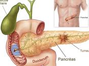 Cáncer páncreas: factores riesgo