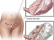 Sindrome Ovarios Poliquísticos