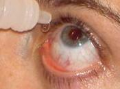 Tratamientos tópicos oculares