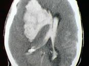 Historias Hemorragia intraparenquimatosa