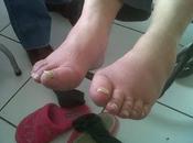 Celulitis