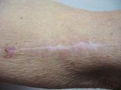 Sarcoidosis subcutanea cicatriz melanoma
