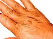 Esclerodermia