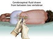 sobre Haemophilus influenza tipo (Hib)