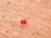 Hemangioma capilar, cómo quitar