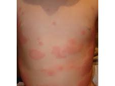 urticaria