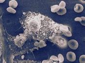 glóbulos blancos modificados pueden eliminar cáncer