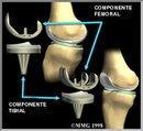 Protesis rodilla fisioterapia terve lucha canaria