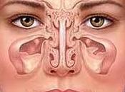 Características sinusitis micótica
