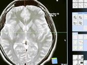Leqembi: fármaco para cerebro (Alzhéimer) daña