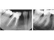 radiografías dentales podrían predecir fracturas óseas futuras