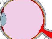 ¿Qué puede causar desprendimiento retina?