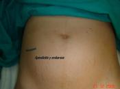 Apendicectomía durante embarazo