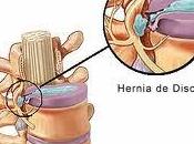 puede curar hernia discal?