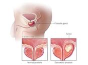 Avances cirugía robótica para tratar cáncer próstata