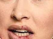 Como cura herpes labial rapidamente