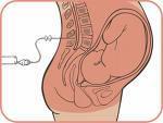 Parir epidural