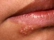 halla relacionado herpes labial