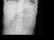 torax bronquiolitis