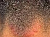 tiña, infección afecta piel: síntomas, causas tratamiento