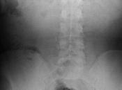 Aparente discartrosis estenosis neuro foramen l5-s1, esto sacralización